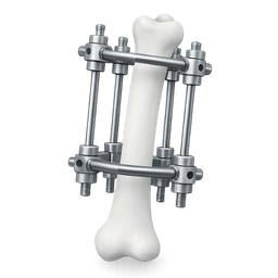 External Fixation